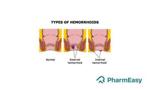 Banding Of Hemorrhoids