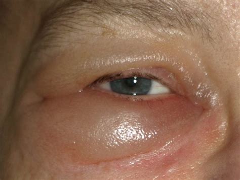 Eyes Swollen From Crying