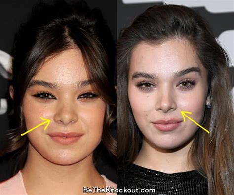 Hailee Steinfeld Plastic Surgery