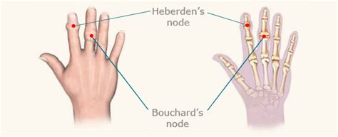 Heberden's And Bouchard's Nodes
