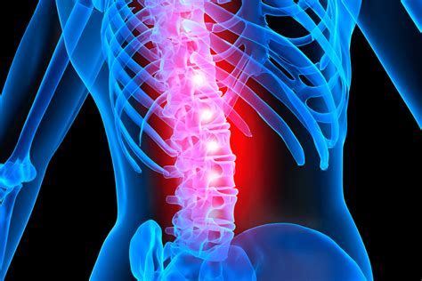 Hohman Lesiones Medulares