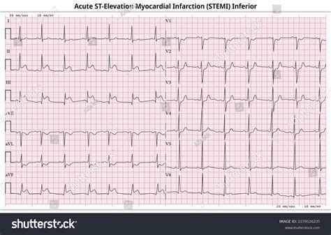 Inferior Infarct Ecg