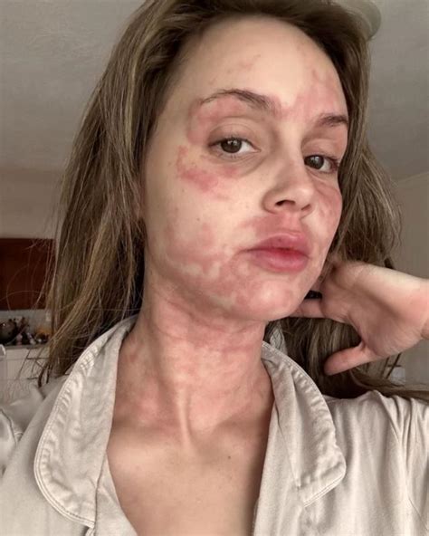 Mikayla Matthews Illness