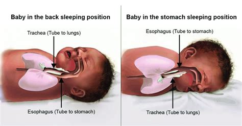 Newborn Choking On Spit