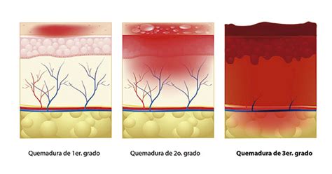 Quemaduras De Tercer Grado