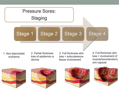 Sacrum Pressure Sores