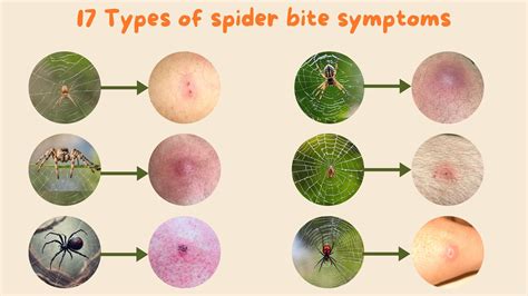 Salticidae Spider Bite