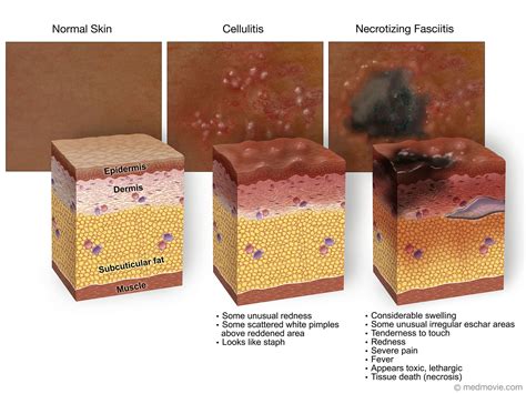 Stages Necrosis Skin